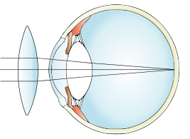 hipermetropia lentile de contact