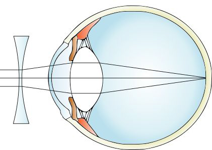 miopia lentile de contact